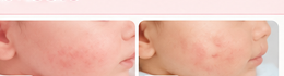 ตัวอย่างภาพก่อน-หลังคู่กับคำเคลมรักษาผื่น ซึ่งไม่ควรใช้